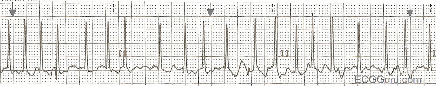 ECG Basics: Atrial Fibrillation With A Rapid Ventricular Response ...